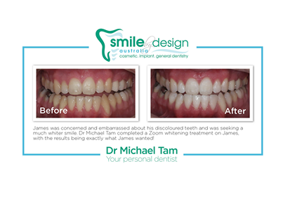 Smile by Design – Win an in chair Zoom whitening treatment – clinic is in Bondi NSW